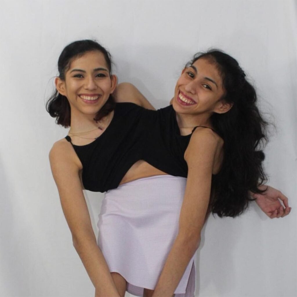 Conjoined Twin Lupita Andrade on Carmen Andrade, Husband Getting Intimate