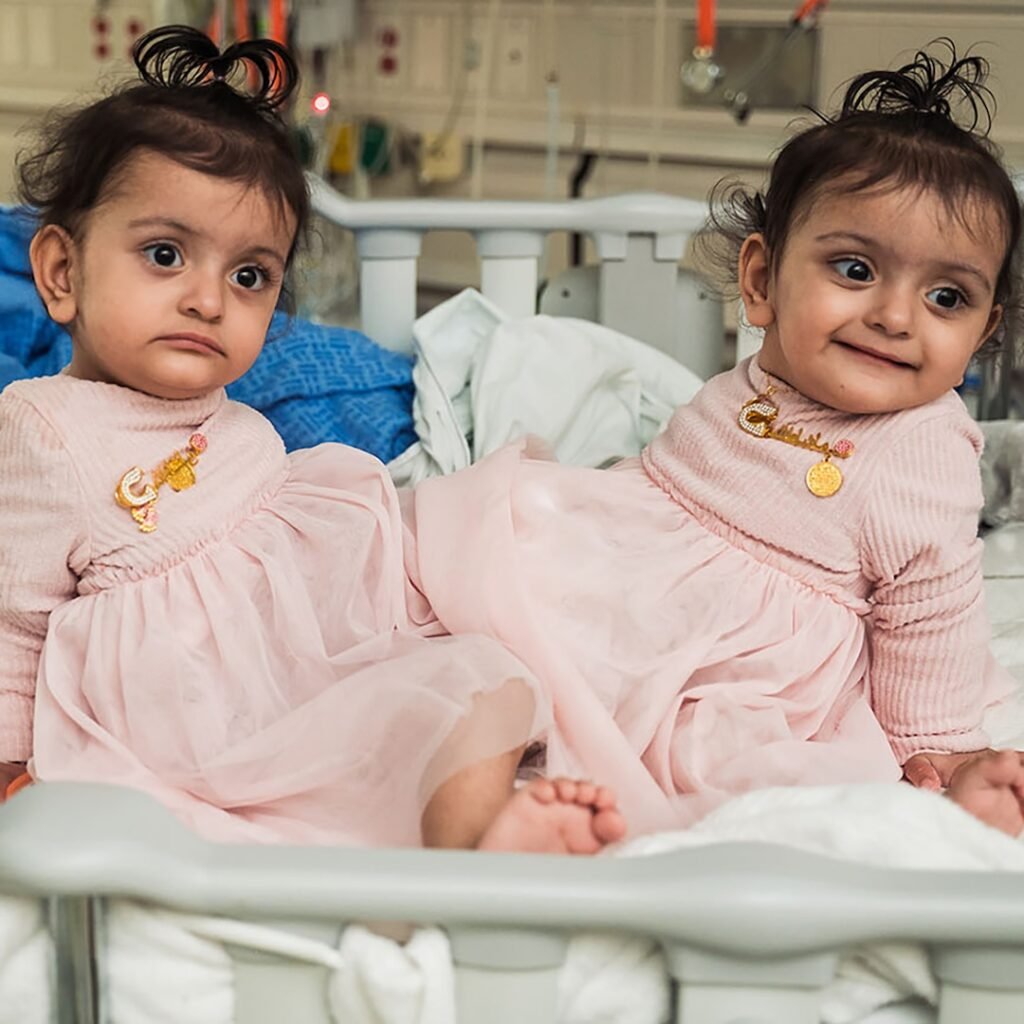 Conjoined Twins Ally and El Separated After Surgery